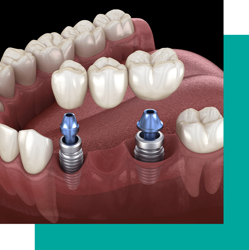 implant supported bridge 3d