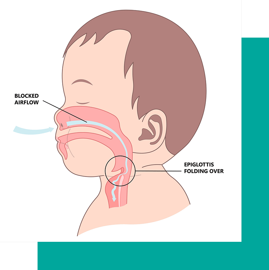 baby diagram having issue breathing