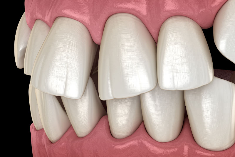 crooked teeth
