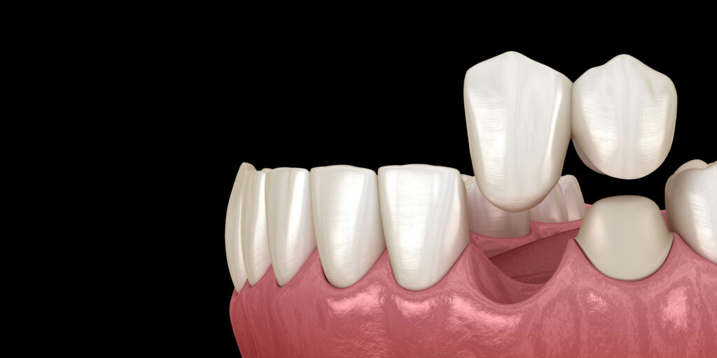 dental bridge two teeth