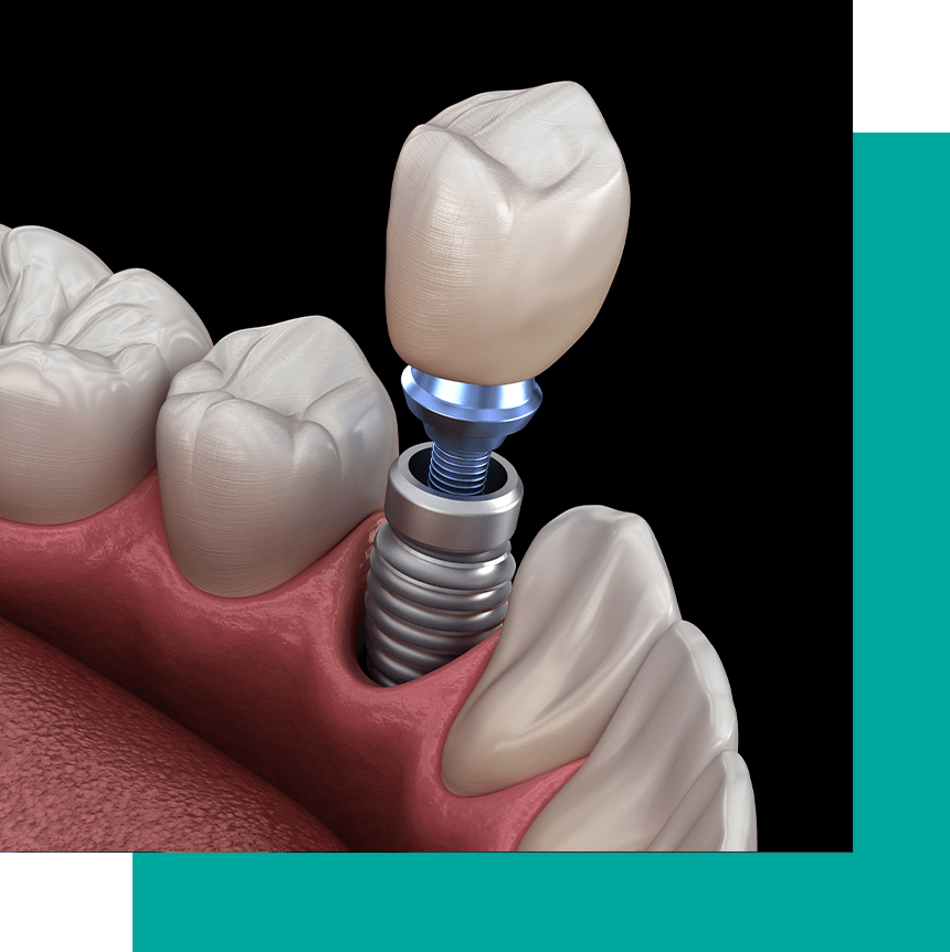 dental implant 3d
