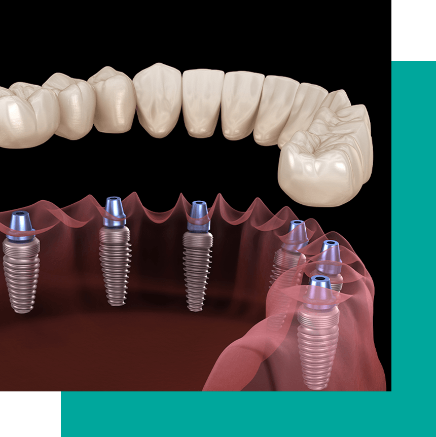 full arch implant 3d