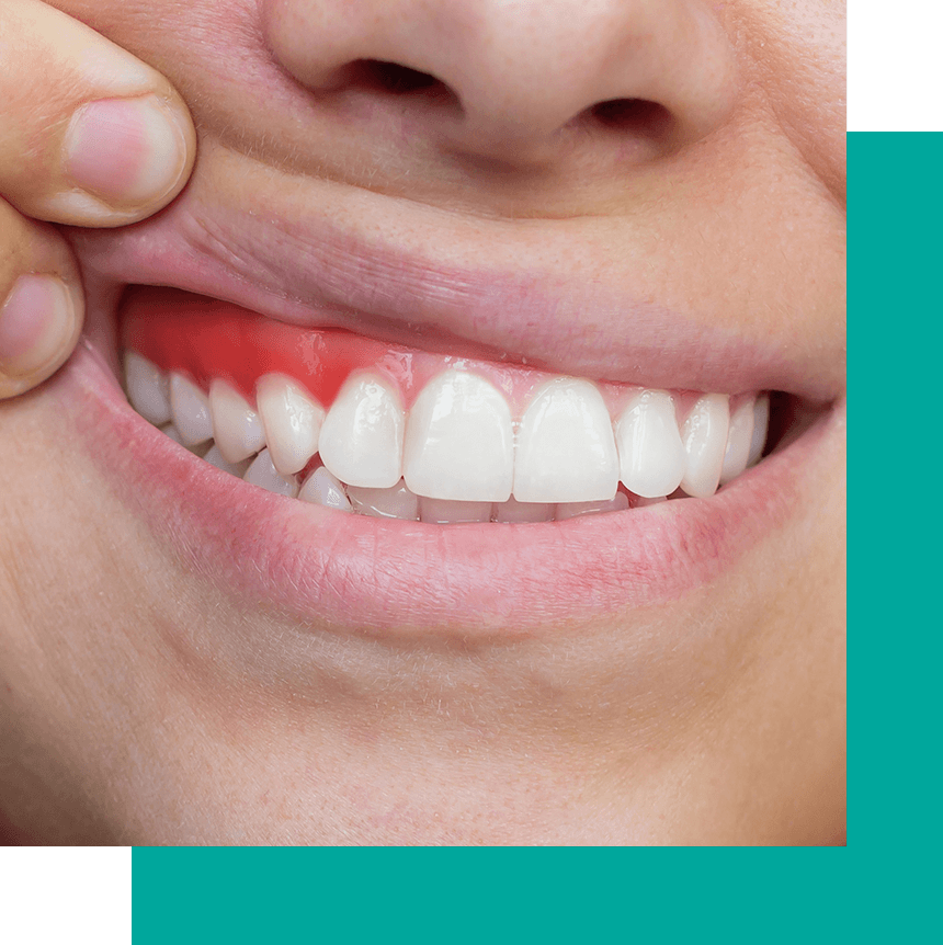 gum disease redness