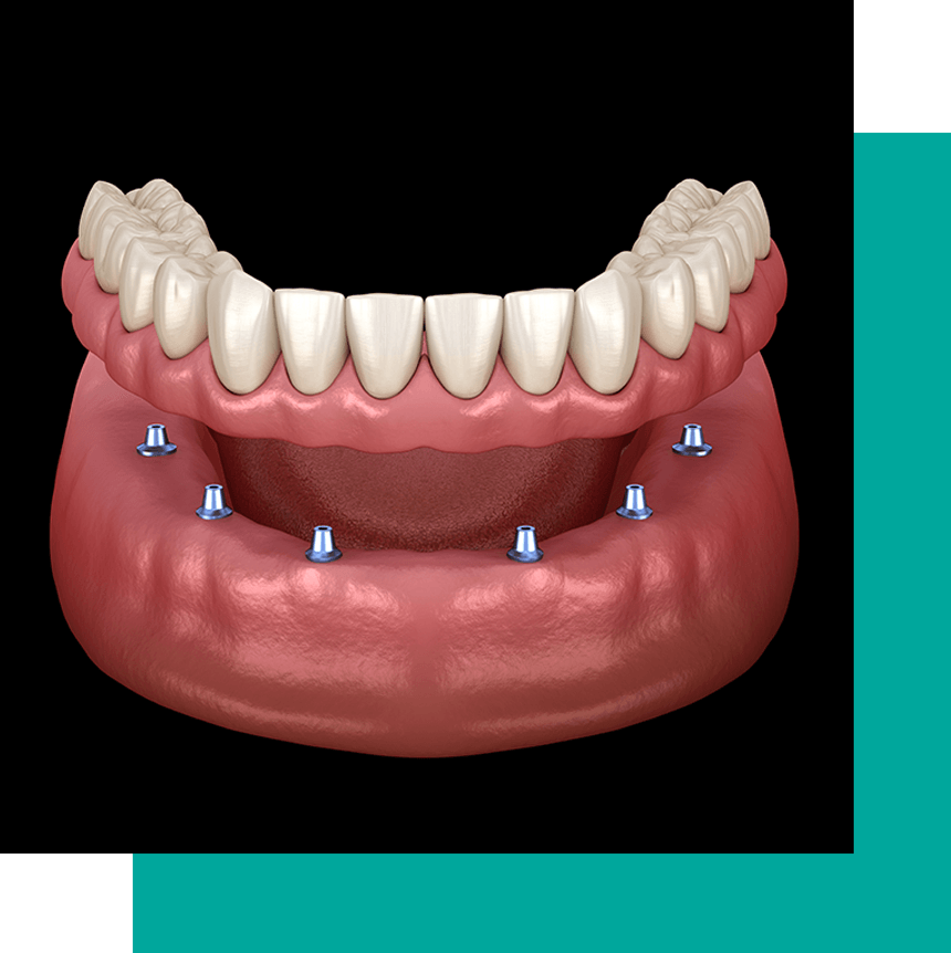 implant supported denture 3d