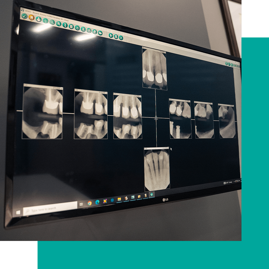 xray scan of teeth