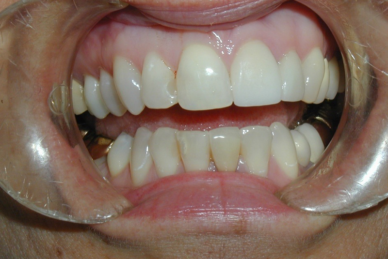 After photo of a dental procedure. Procedure unknown.