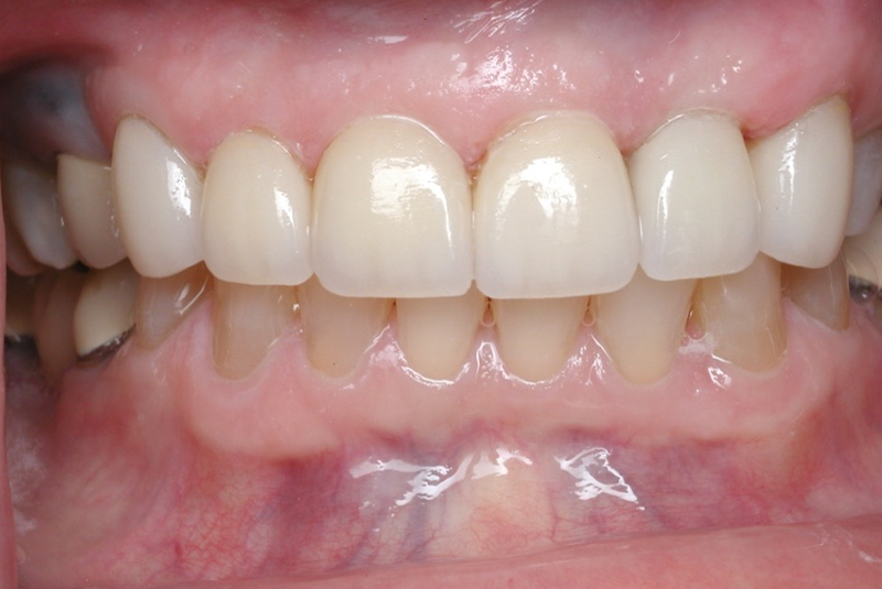 After photo of a dental procedure. Procedure unknown.