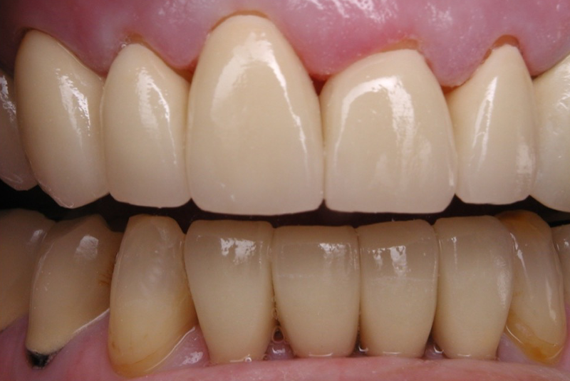 After photo of a dental procedure. Procedure unknown.