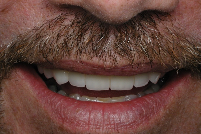 After photo of a dental procedure. Procedure unknown.