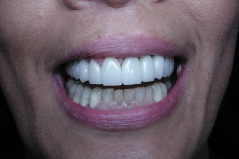 After photo of a dental procedure. Procedure unknown.