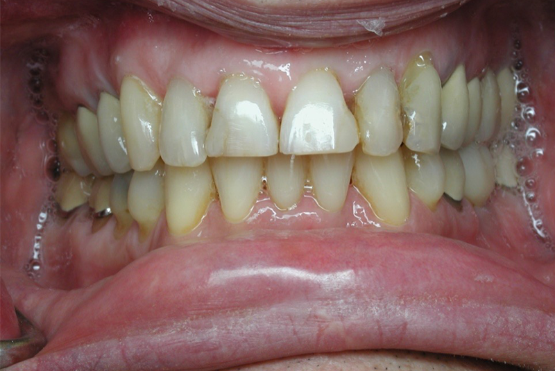 Before photo of a dental procedure. Procedure unknown.