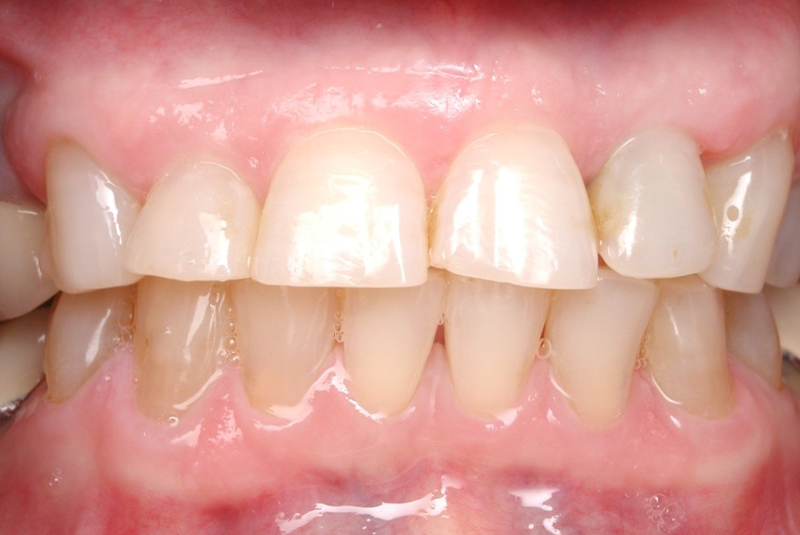 Before photo of a dental procedure. Procedure unknown.