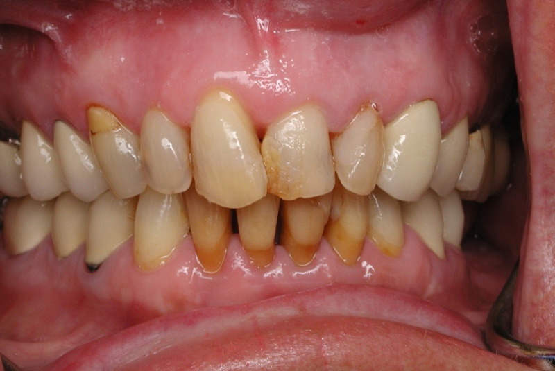 Before photo of a dental procedure. Procedure unknown.