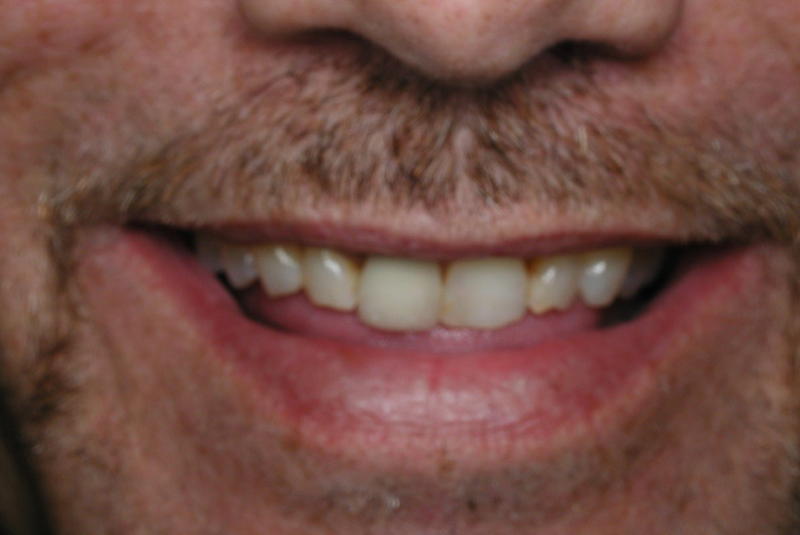 Before photo of a dental procedure. Procedure unknown.