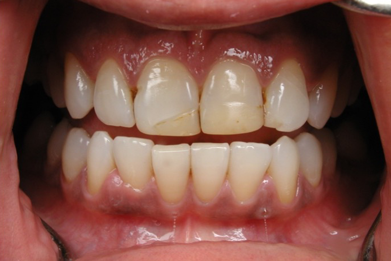 Before photo of a dental procedure. Procedure unknown.