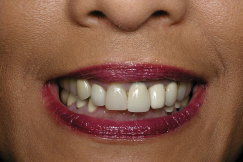 Before photo of a dental procedure. Procedure unknown.