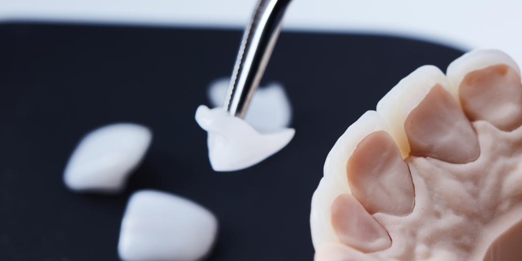 example of a porcelain veneer on a prosthesis