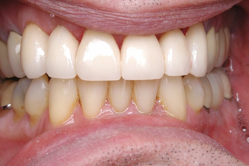 After photo of a dental procedure. Procedure unknown.