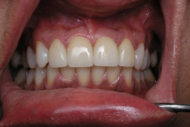 After photo of a dental procedure. Procedure unknown.