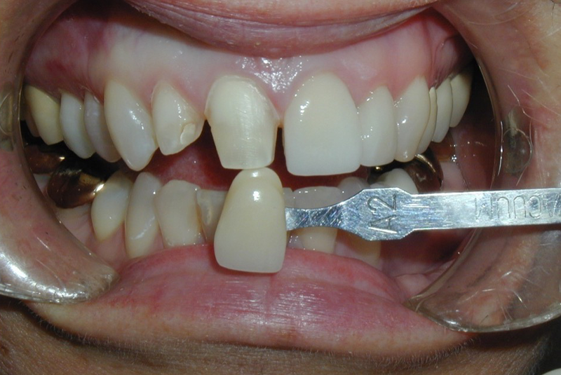 Before photo of a dental procedure. Procedure unknown.